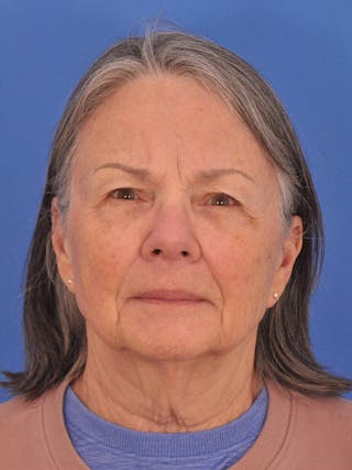 BBL & Moxi Before & After Gallery - Patient 412571 - Image 2