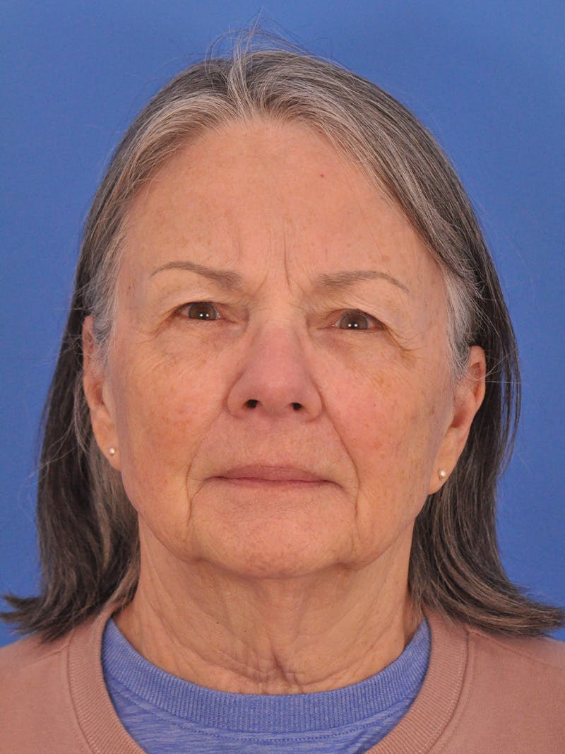 BBL & Moxi Before & After Gallery - Patient 412571 - Image 2