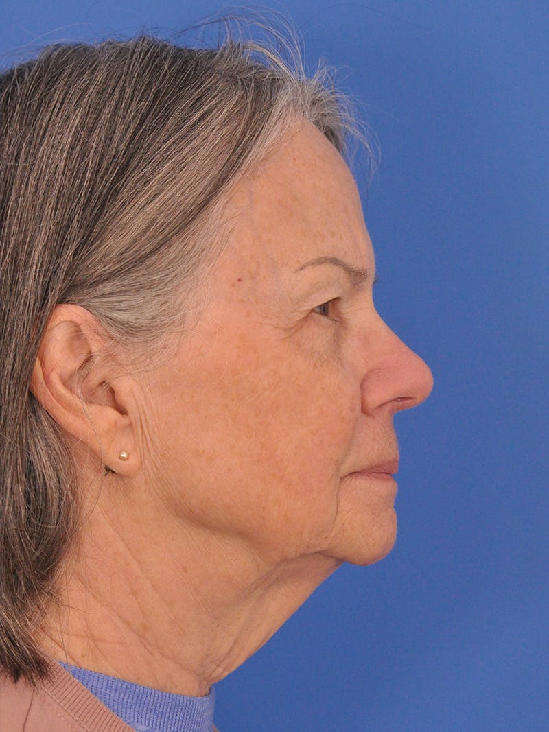 BBL & Moxi Before & After Gallery - Patient 412571 - Image 6