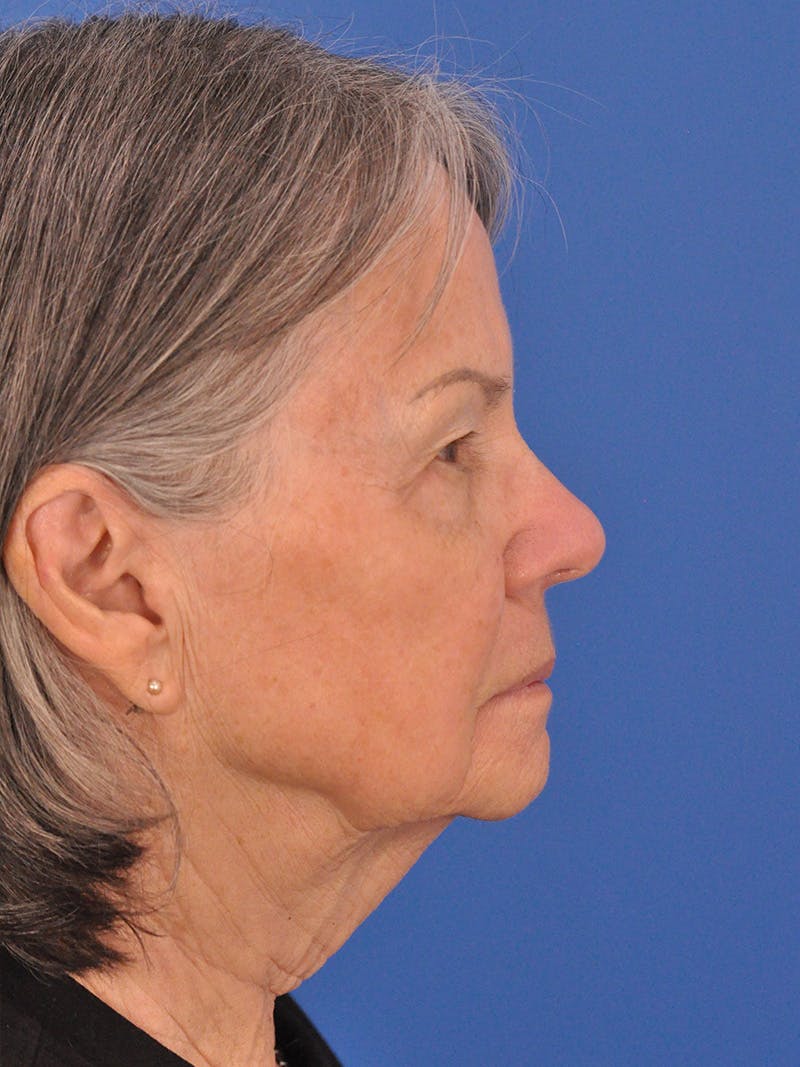 BBL & Moxi Before & After Gallery - Patient 412571 - Image 5