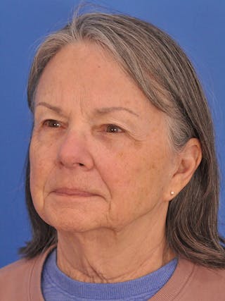 BBL & Moxi Before & After Gallery - Patient 412571 - Image 8