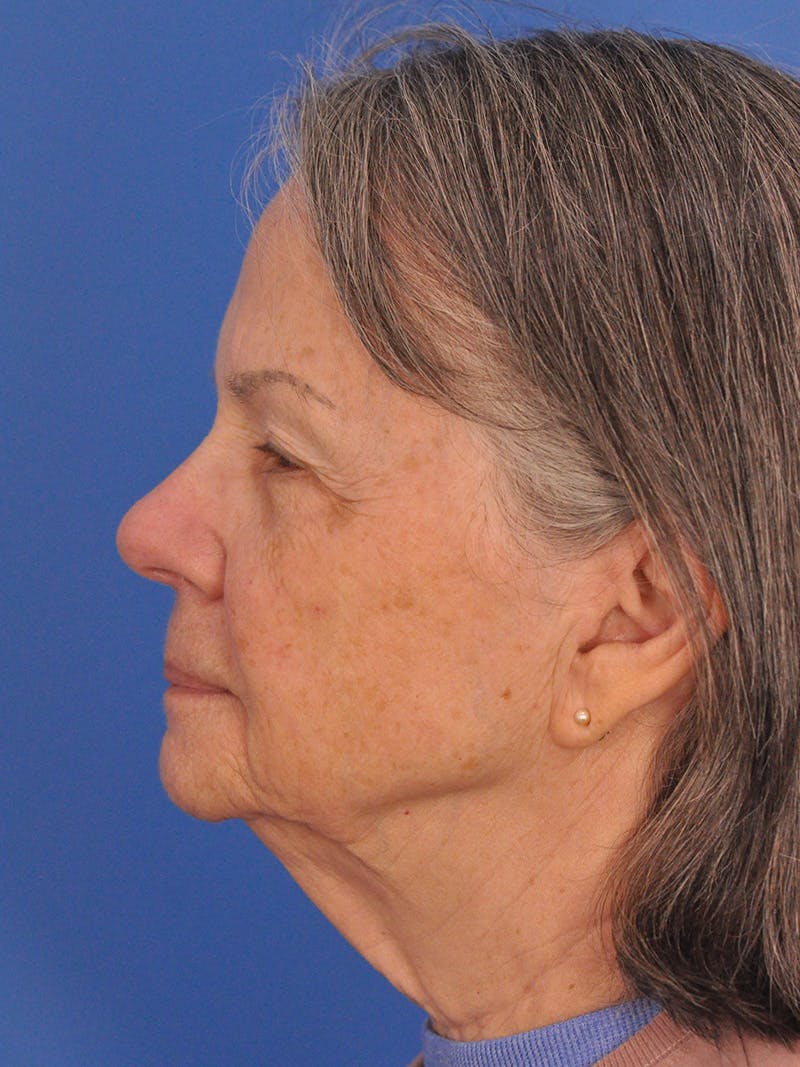BBL & Moxi Before & After Gallery - Patient 412571 - Image 10