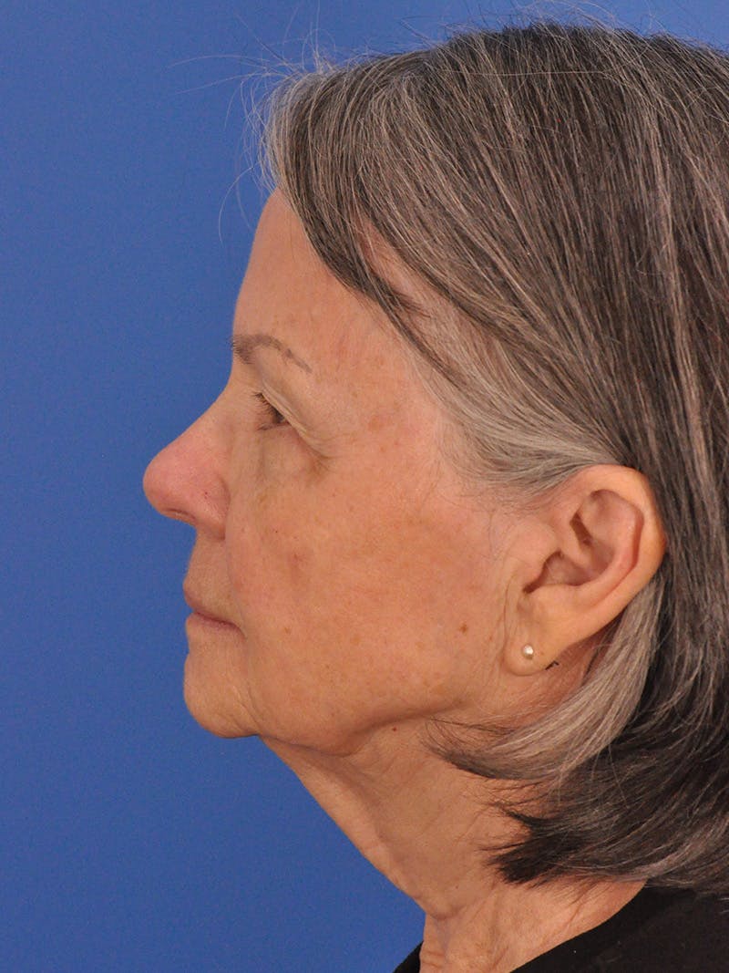 BBL & Moxi Before & After Gallery - Patient 412571 - Image 9
