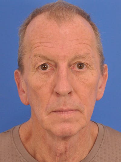 CO2RE Laser Before & After Gallery - Patient 317231 - Image 1