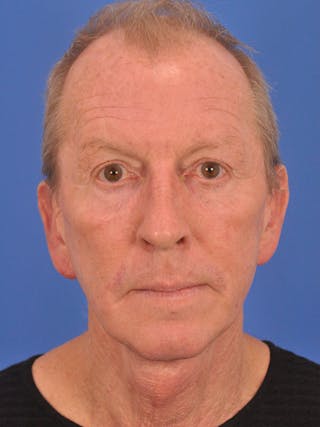Facelift Before & After Gallery - Patient 428156 - Image 2