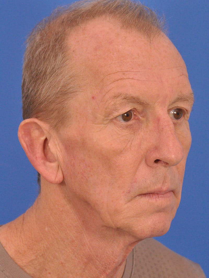 Facelift Before & After Gallery - Patient 428156 - Image 3