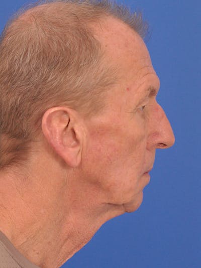 Neck Lift Before & After Gallery - Patient 306791 - Image 1