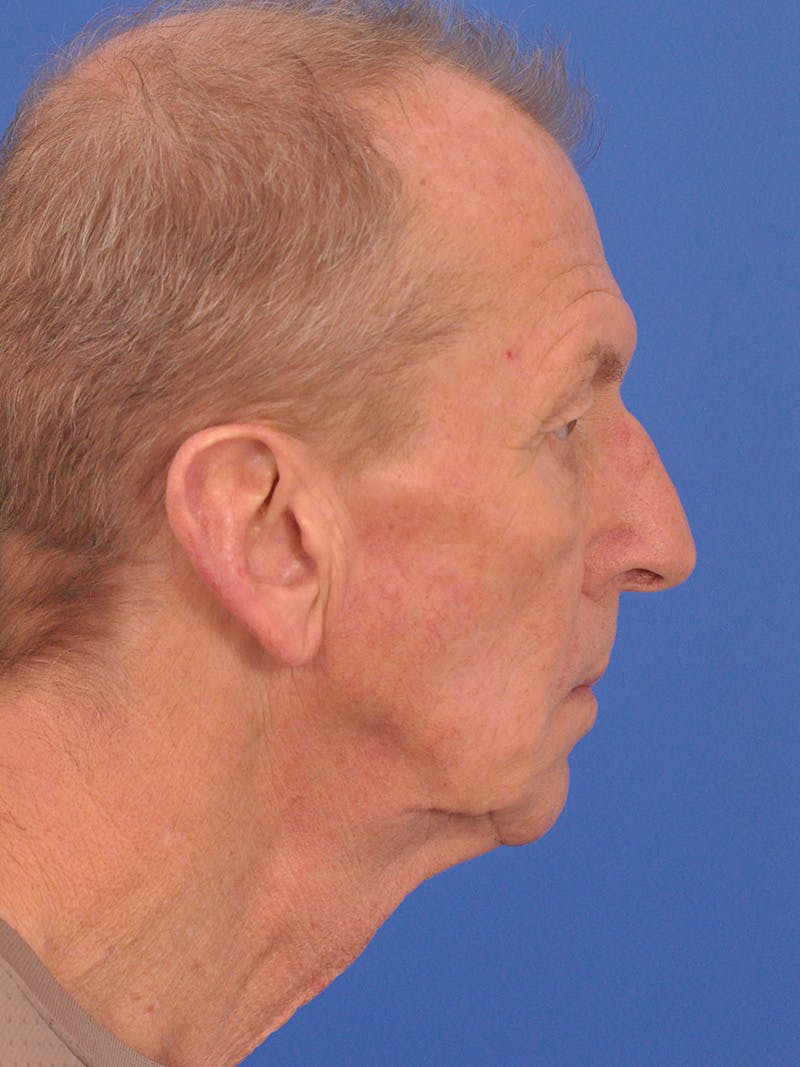 Facelift Before & After Gallery - Patient 428156 - Image 5