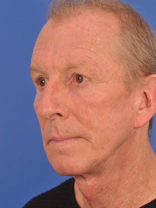 Facelift Before & After Gallery - Patient 428156 - Image 8