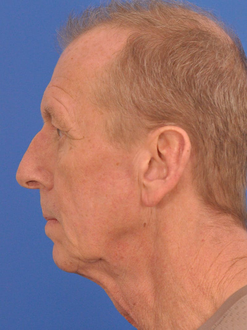Facelift Before & After Gallery - Patient 428156 - Image 9
