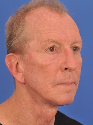 Facelift Before & After Gallery - Patient 428156 - Image 4