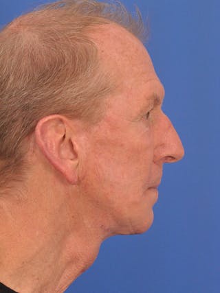 Facelift Before & After Gallery - Patient 428156 - Image 6