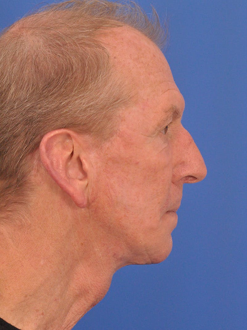Facelift Before & After Gallery - Patient 428156 - Image 6