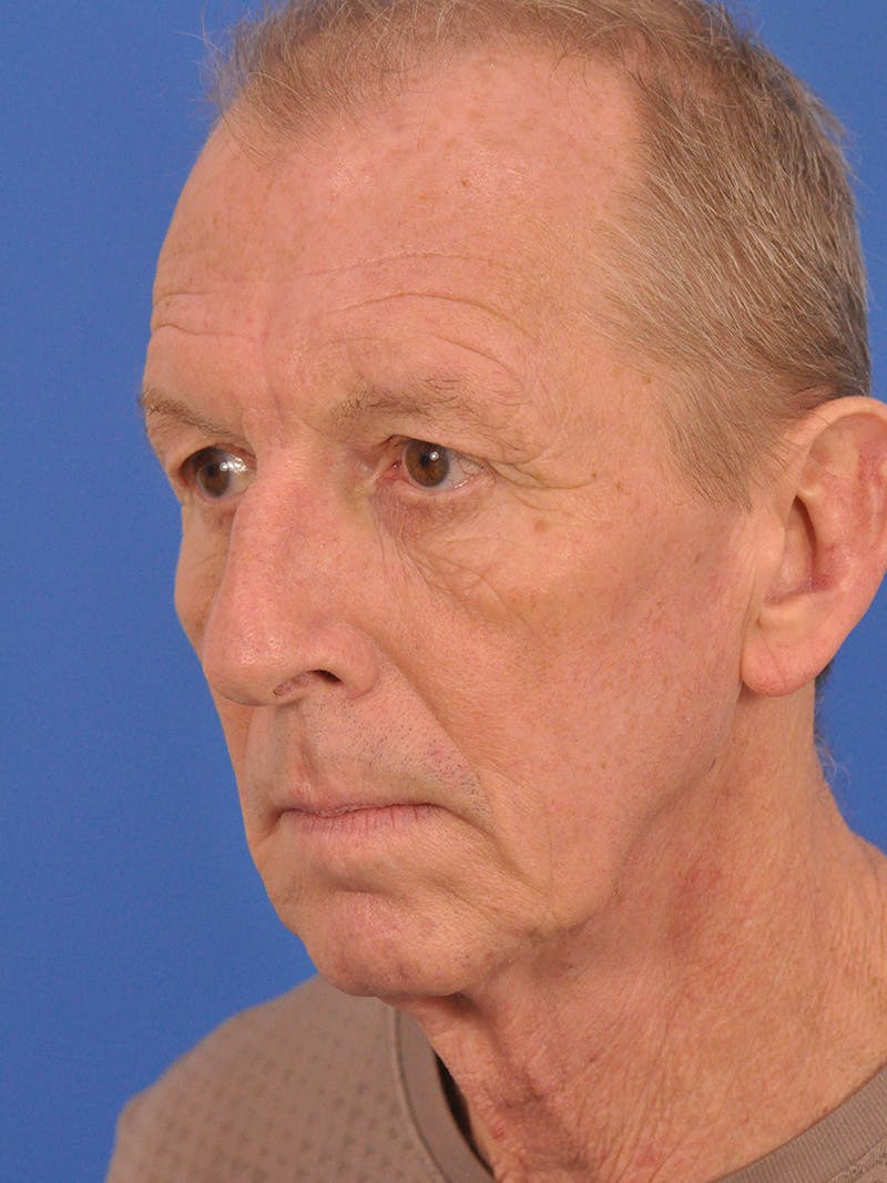 Facelift Before & After Gallery - Patient 428156 - Image 7