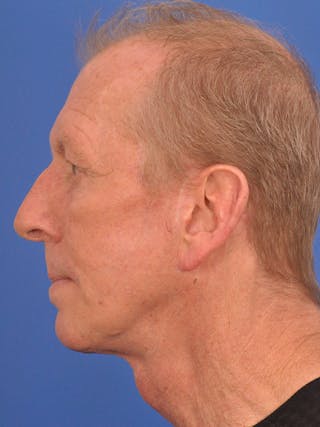 Facelift Before & After Gallery - Patient 428156 - Image 10