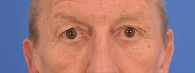 Blepharoplasty Before & After Gallery - Patient 599309 - Image 1