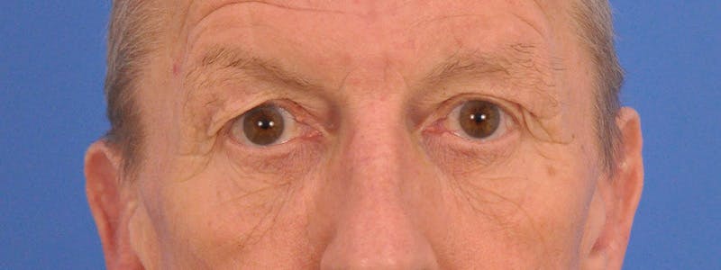 Blepharoplasty Before & After Gallery - Patient 599309 - Image 1