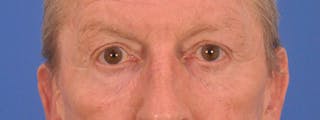 Blepharoplasty Before & After Gallery - Patient 599309 - Image 2