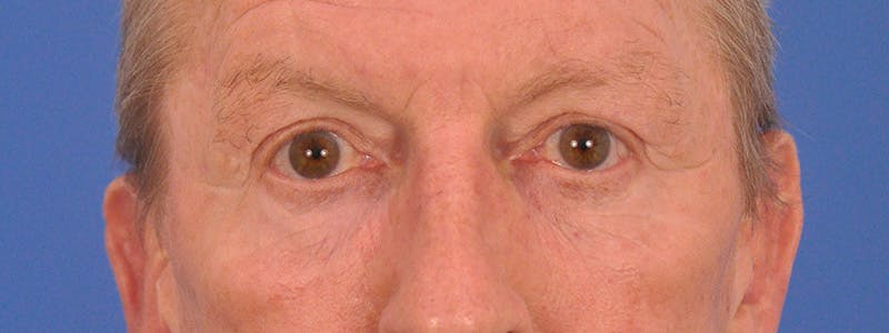 Blepharoplasty Before & After Gallery - Patient 599309 - Image 2