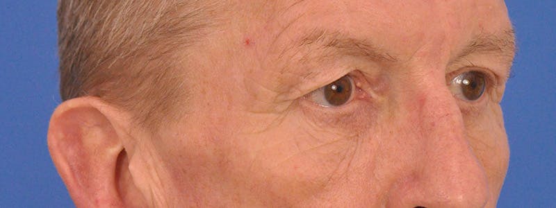 Blepharoplasty Before & After Gallery - Patient 599309 - Image 3