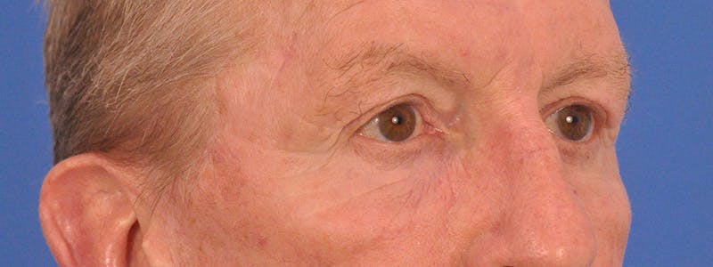Blepharoplasty Before & After Gallery - Patient 599309 - Image 4