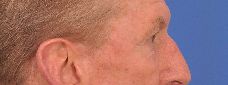 Blepharoplasty Before & After Gallery - Patient 599309 - Image 6