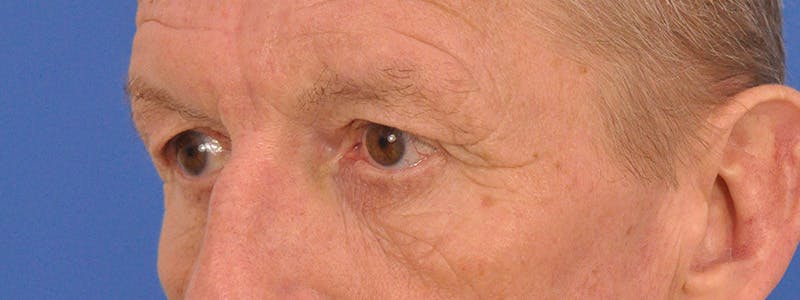 Blepharoplasty Before & After Gallery - Patient 599309 - Image 7