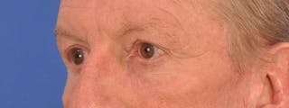 Blepharoplasty Before & After Gallery - Patient 599309 - Image 8