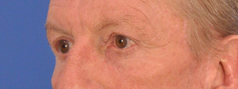 Blepharoplasty Before & After Gallery - Patient 599309 - Image 8