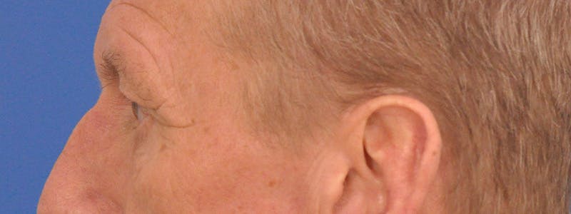 Blepharoplasty Before & After Gallery - Patient 599309 - Image 9