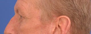 Blepharoplasty Before & After Gallery - Patient 599309 - Image 10