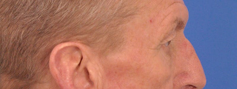 Blepharoplasty Before & After Gallery - Patient 599309 - Image 5
