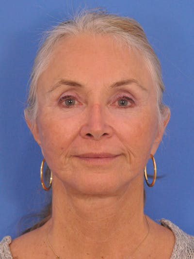 Brow Lift Before & After Gallery - Patient 407306 - Image 2