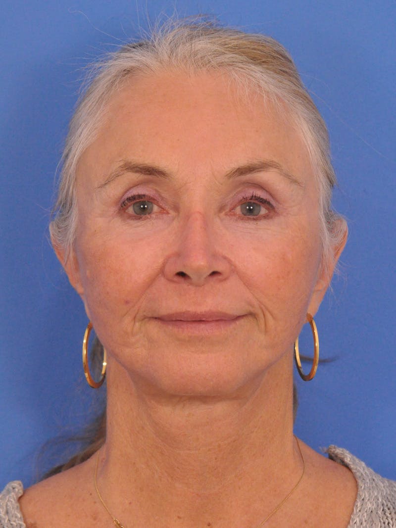 Facelift Before & After Gallery - Patient 233651 - Image 2