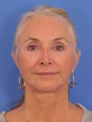 Facelift Before & After Gallery - Patient 233651 - Image 2
