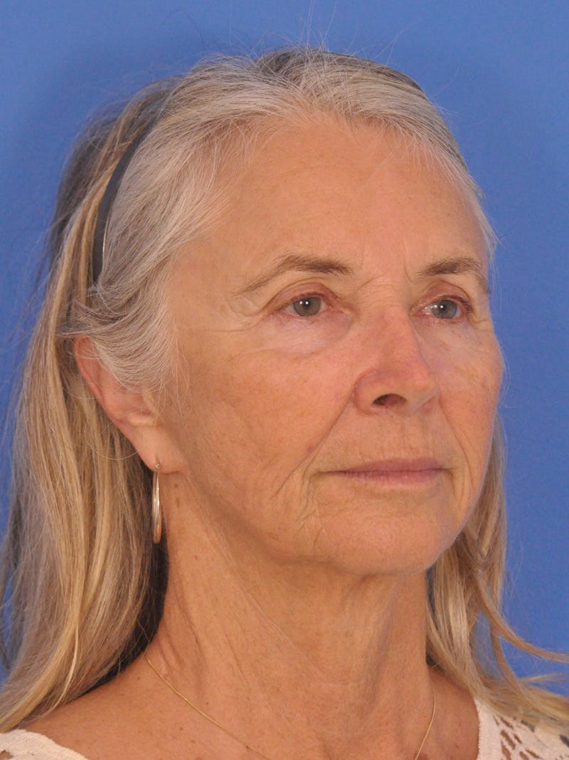 Facelift Before & After Gallery - Patient 233651 - Image 3