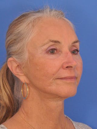 Facelift Before & After Gallery - Patient 233651 - Image 4