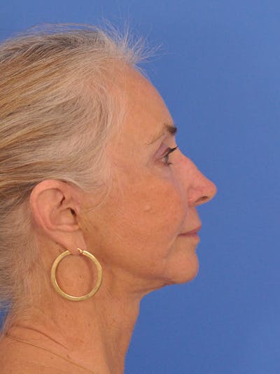 Neck Lift Before & After Gallery - Patient 257390 - Image 2