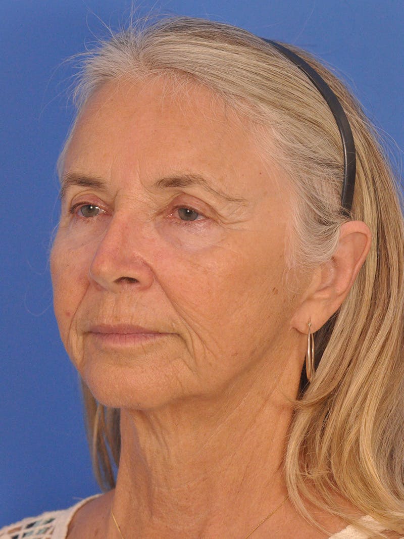 Facelift Before & After Gallery - Patient 233651 - Image 7