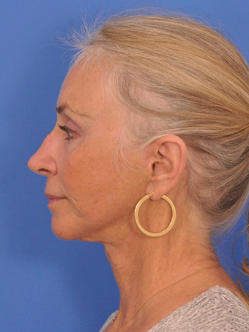 Facelift Before & After Gallery - Patient 233651 - Image 10