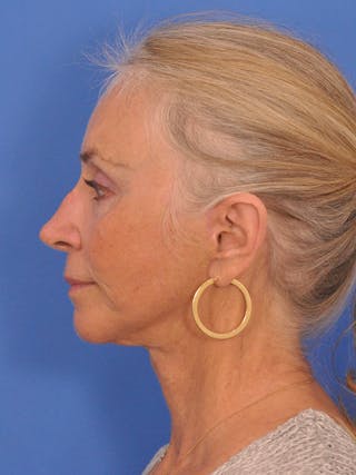 Facelift Before & After Gallery - Patient 233651 - Image 10