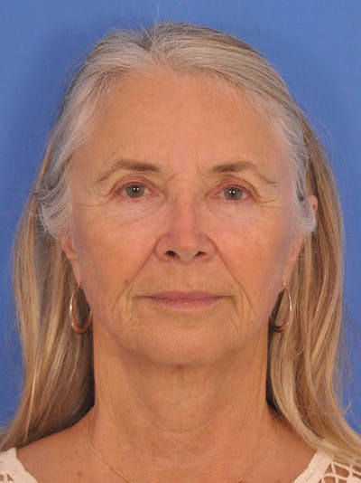 Brow Lift Before & After Gallery - Patient 407306 - Image 1