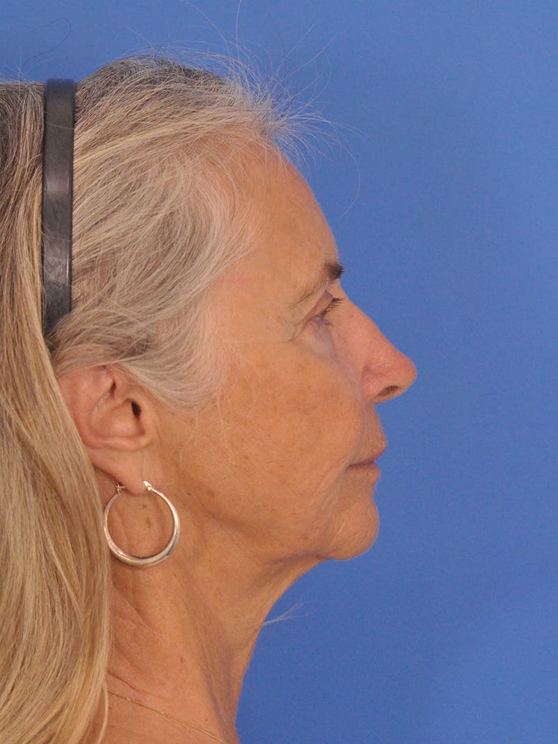 Facelift Before & After Gallery - Patient 233651 - Image 5