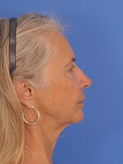 Neck Lift Before & After Gallery - Patient 257390 - Image 1