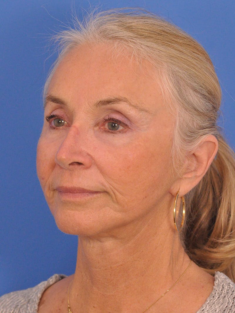 Facelift Before & After Gallery - Patient 233651 - Image 8