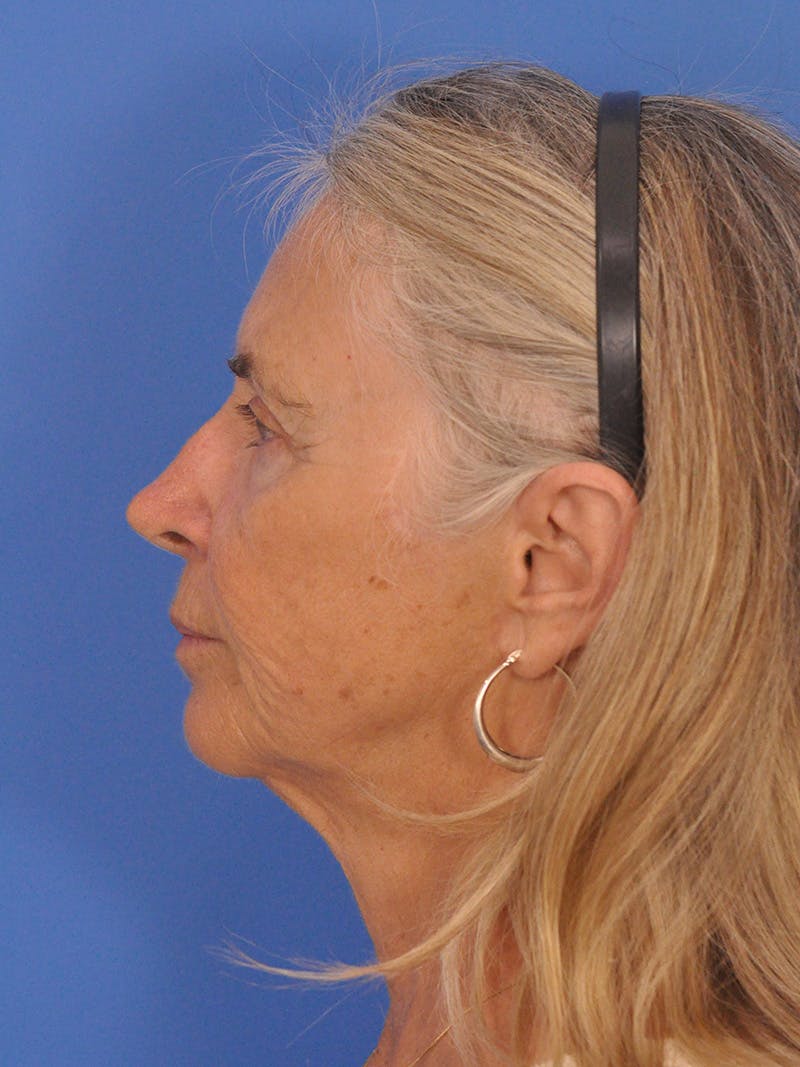 Facelift Before & After Gallery - Patient 233651 - Image 9