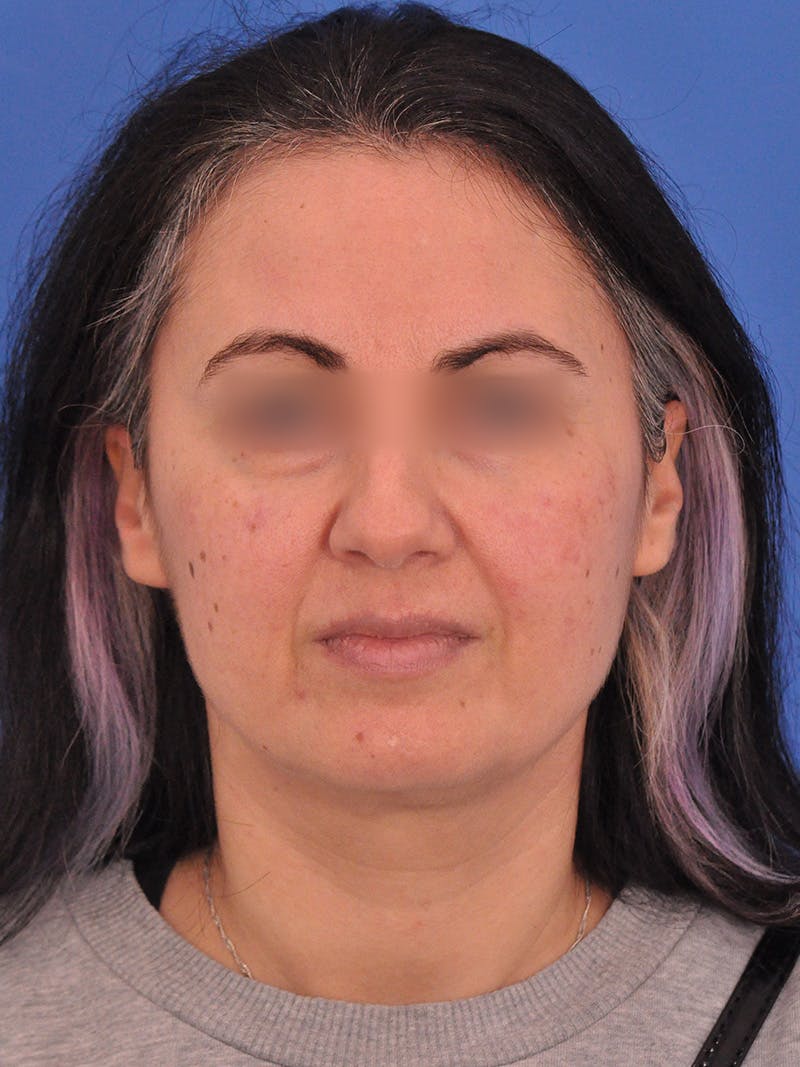 Facelift Before & After Gallery - Patient 215528 - Image 1