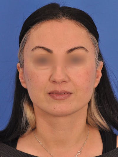 Brow Lift Before & After Gallery - Patient 105913 - Image 2