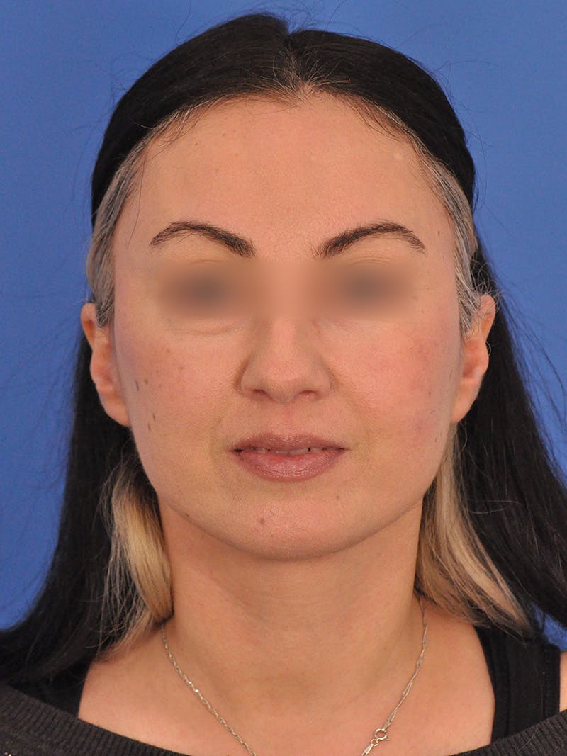 Facelift Before & After Gallery - Patient 215528 - Image 2