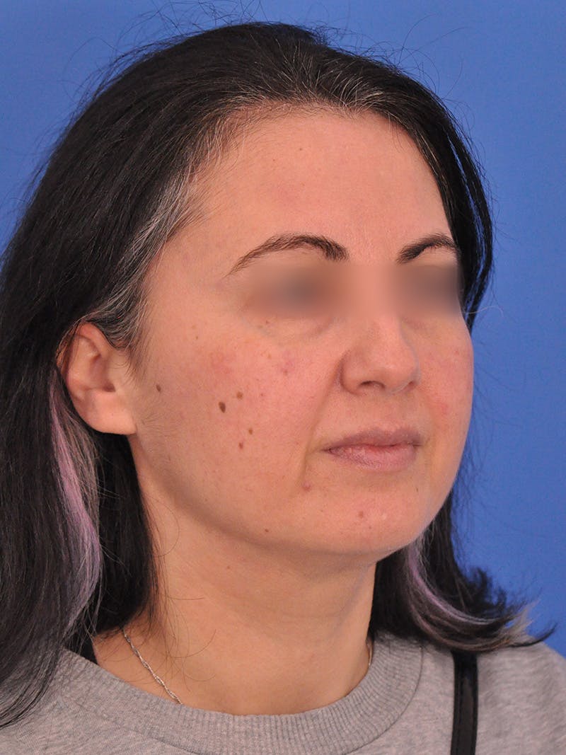 Facelift Before & After Gallery - Patient 215528 - Image 3